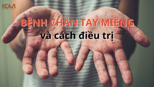 Bệnh tay chân miệng và cách điều trị